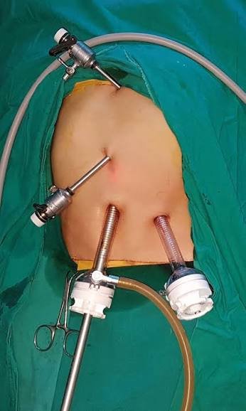 Laparoscopic Splenectomy