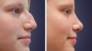 Rhinoplasty