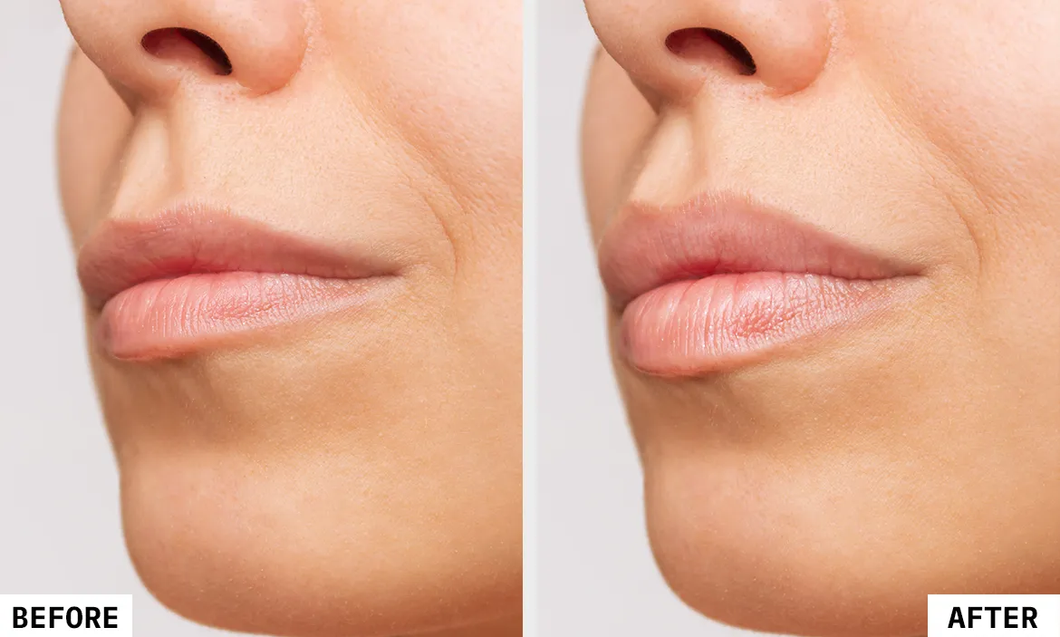 Filler Treatment