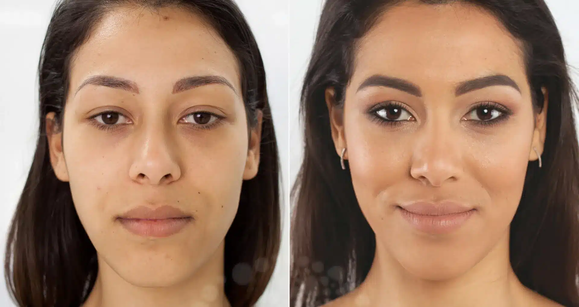 Cheek Augmentation