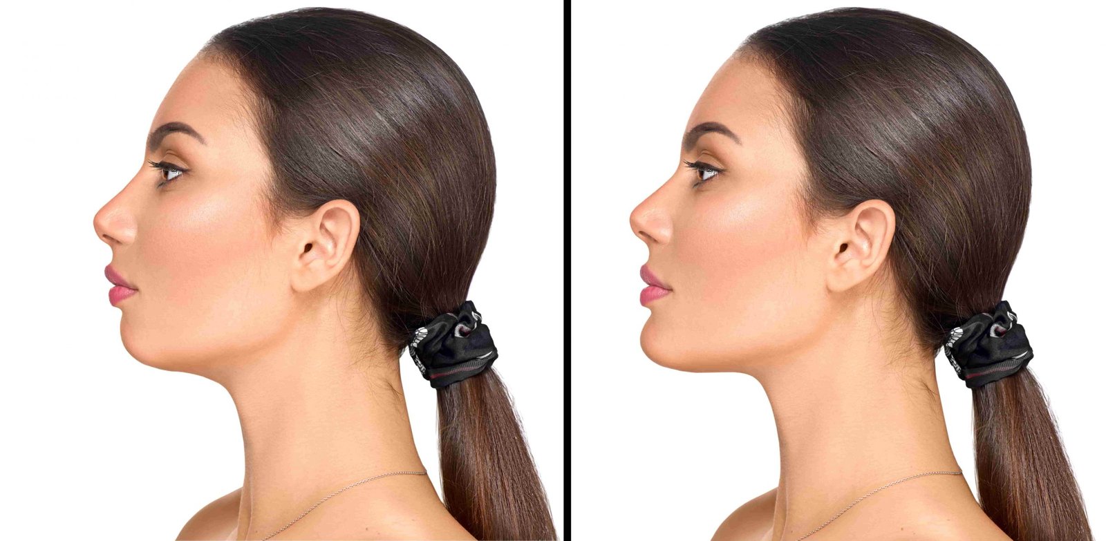 Genioplasty (Chin surgery)