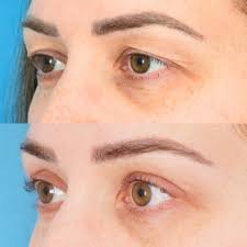 Blepharoplasty (eyelid surgery)