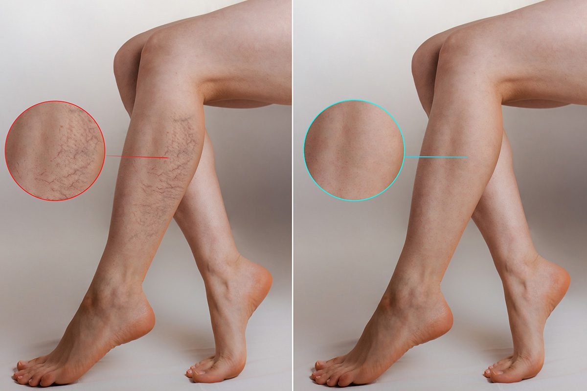 Spider Vein Treatment