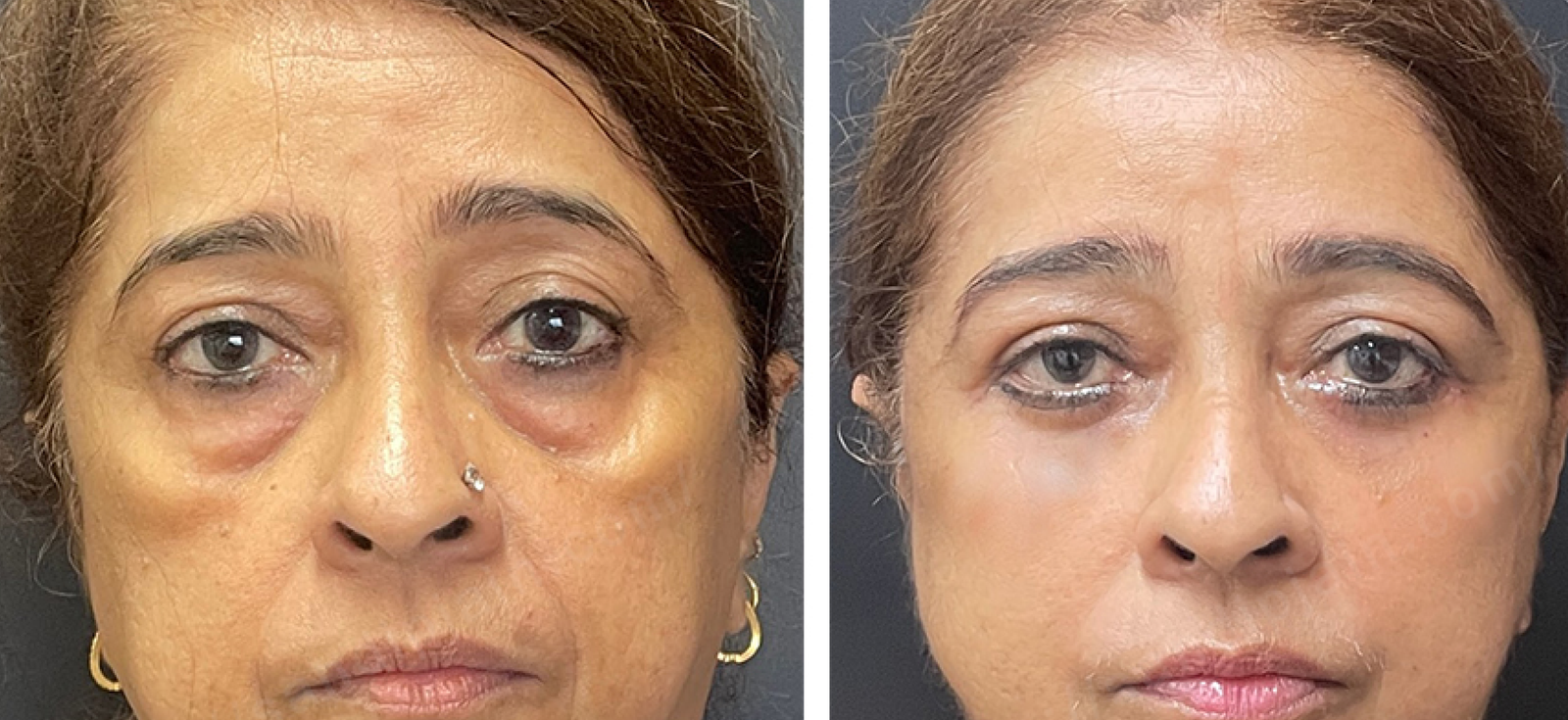 Facelift Surgery