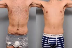 Tummy Tuck