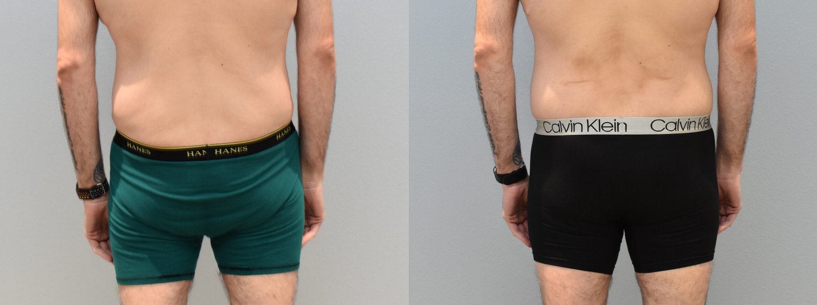 Brazilian Butt Lift Procedure