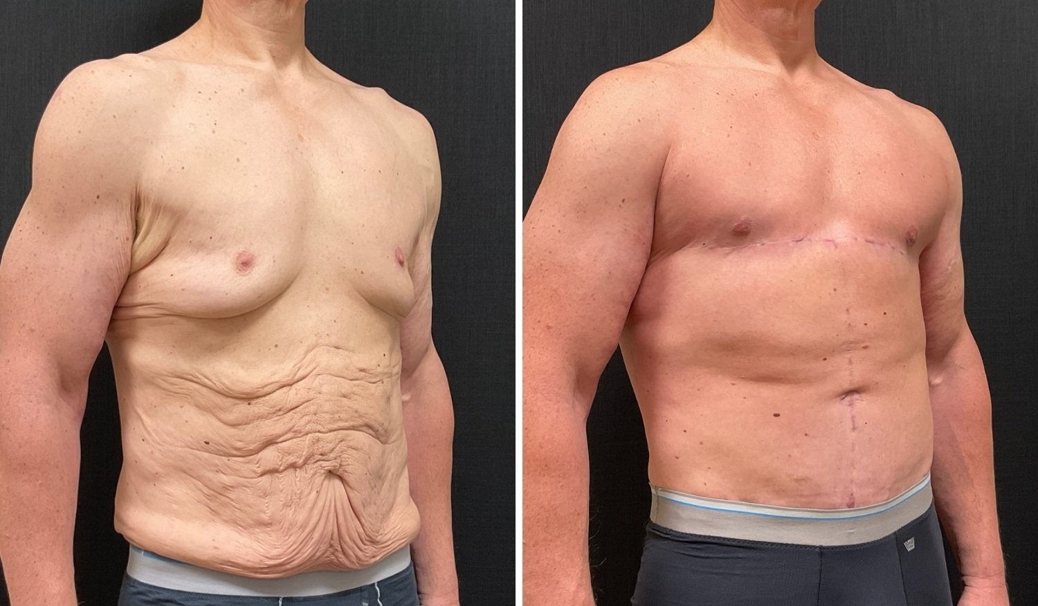 Body Contouring Surgery