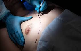 Breast Reduction Surgery