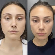 Buccal Fat Removal Surgery