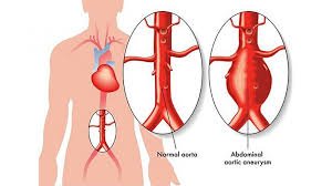 Endovascular Aneurysm Repair